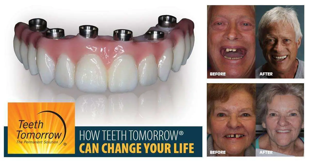 Advanced Dental Dental Implants