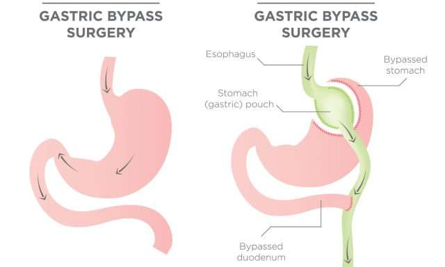 BCBS of Alabama Bariatric Surgery: Requirements, Options ...