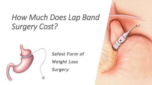 How Much Does Lap Band Surgery Cost?