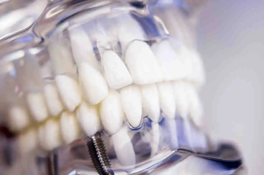 Do medicaid pay for dental implants?