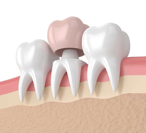 Does Medicaid Cover Dental Crowns In Nc