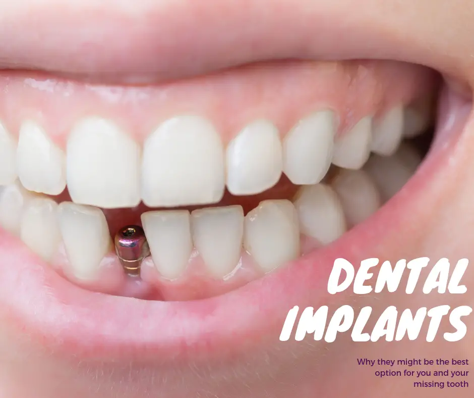 Does Wellcare Pay For Dental Implants