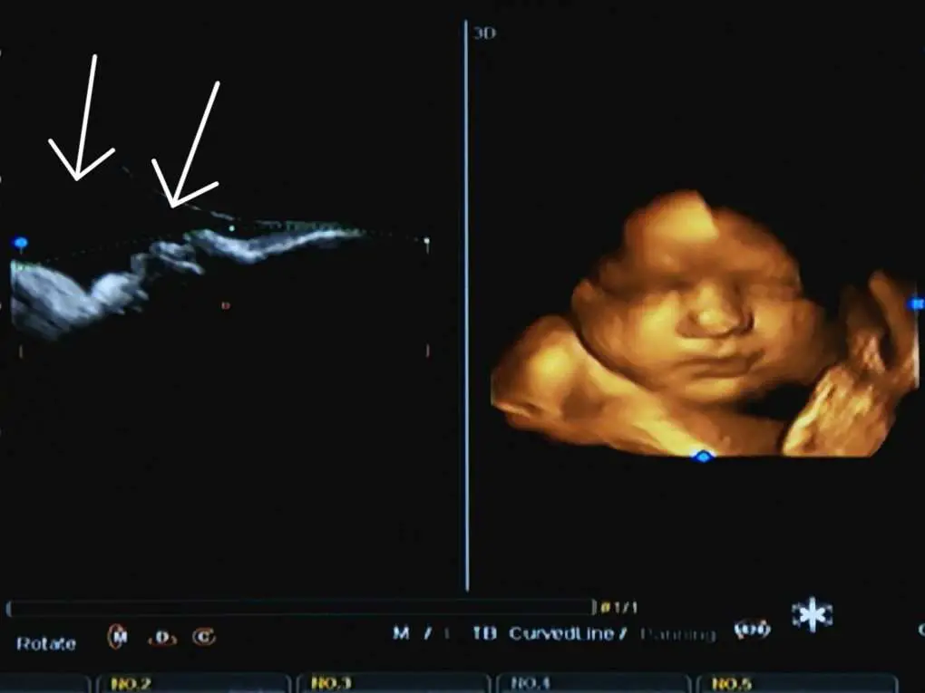 How To Get The Best 3D Ultrasound Pictures