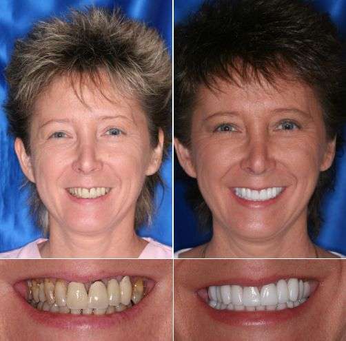 Cost Of Wisdom Teeth Removal Aspen Dental