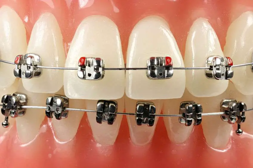 Comfort Dental Braces Loveland: Are Braces Covered By Medicaid?