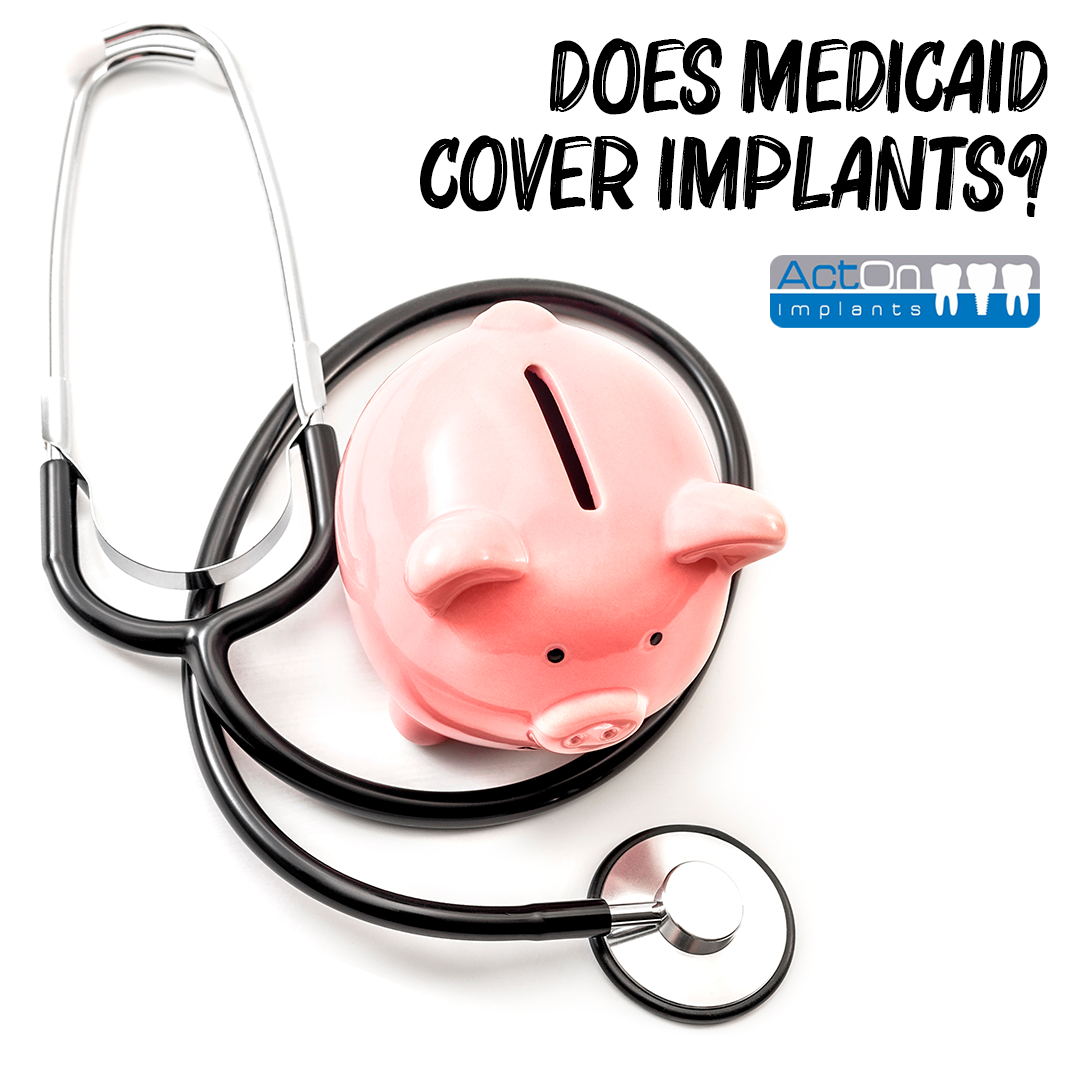 Does Medicaid Cover Dental Implants?