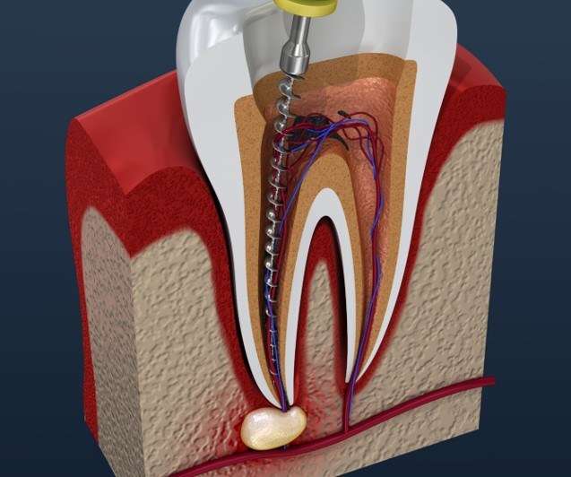 Does Medicaid Cover Root Canals?