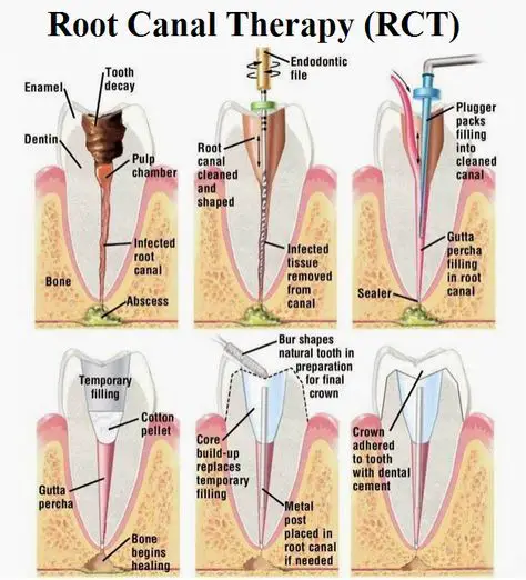 During the root canal therapy, the inflamed or infected pulp is removed ...