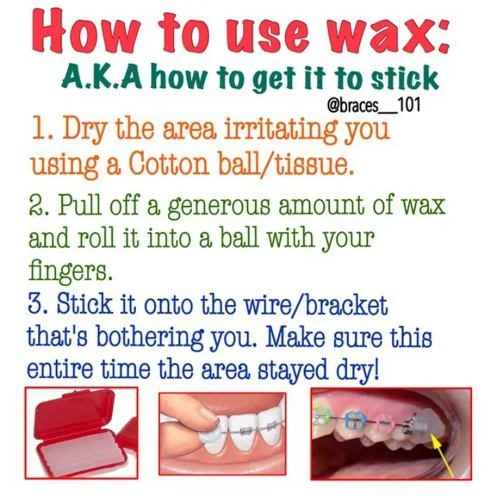 How to use Orthodontic Wax