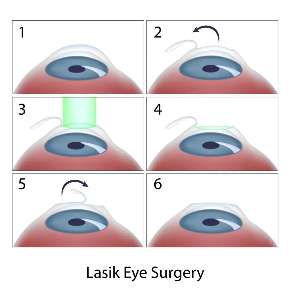 Cost of LASIK Eye Surgery in 2022 (With &  Without Insurance) (2022)