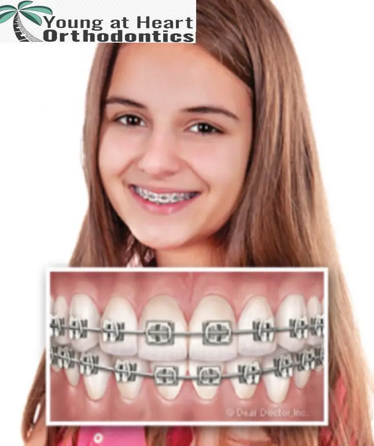 How Much Are Braces A Month Without Insurance